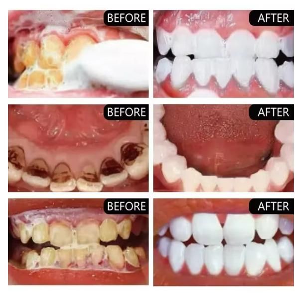 Before and after images showing teeth whitening results using teeth whitening toothpaste for smokers