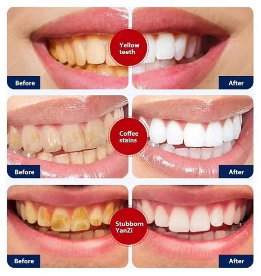 Before and after images showing teeth whitening toothpaste for smokers removing yellow teeth coffee stains and stubborn stains